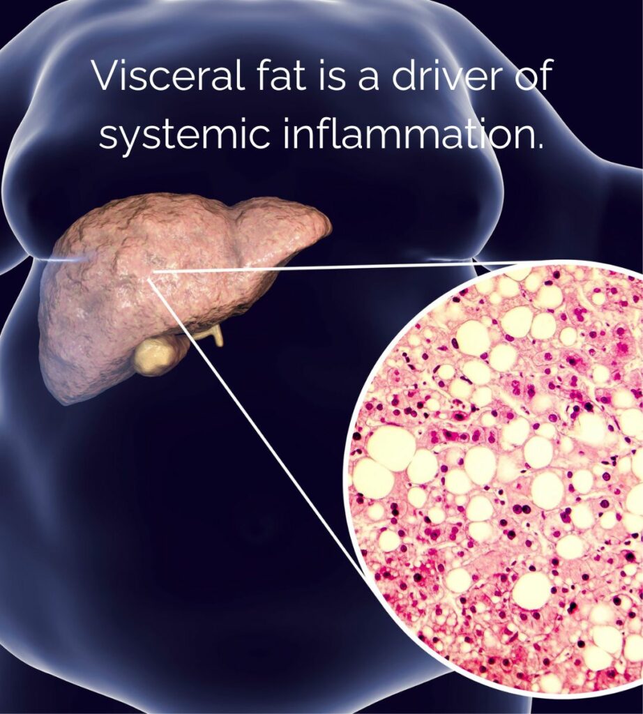 Visceral fat is associated with metabolic syndrome and systemic inflammation, and is a stronger predictor of osteoarthritis than bodyweight alone.